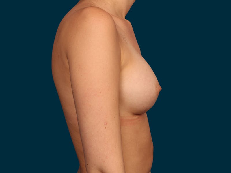 Breast Augmentation Before & After Gallery - Patient 134618 - Image 8