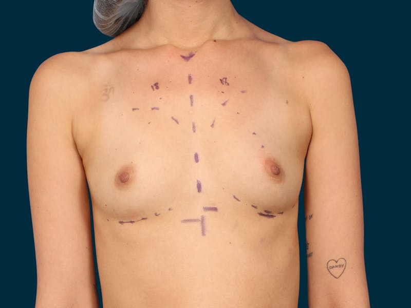 Breast Augmentation Before & After Gallery - Patient 134618 - Image 1
