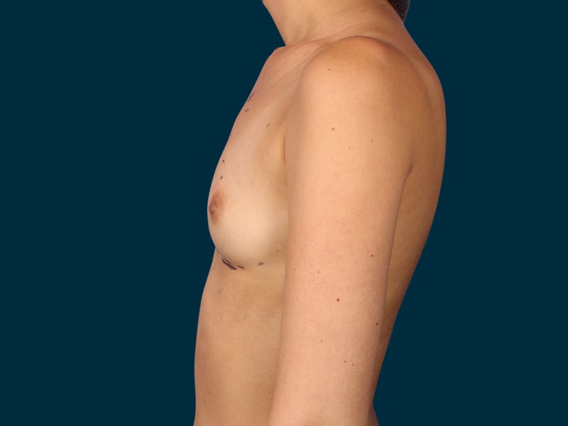 Breast Augmentation Before & After Gallery - Patient 134618 - Image 9