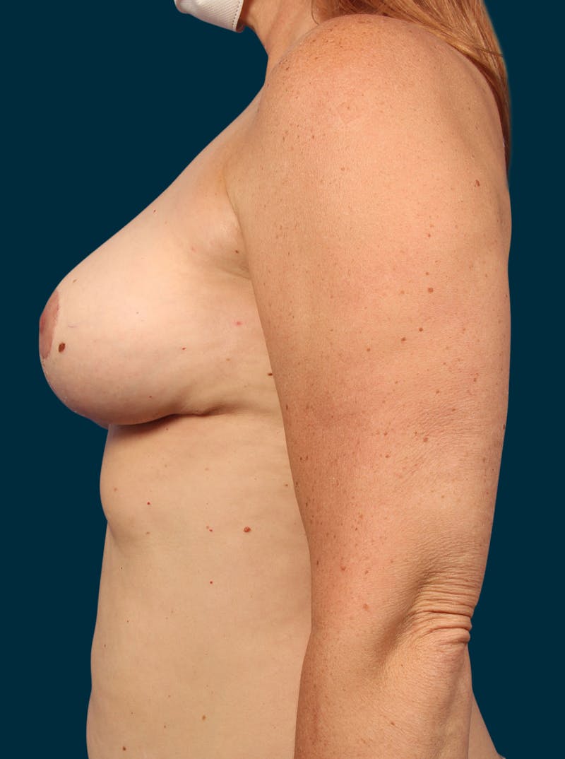 Breast Lift Before & After Gallery - Patient 498311 - Image 4