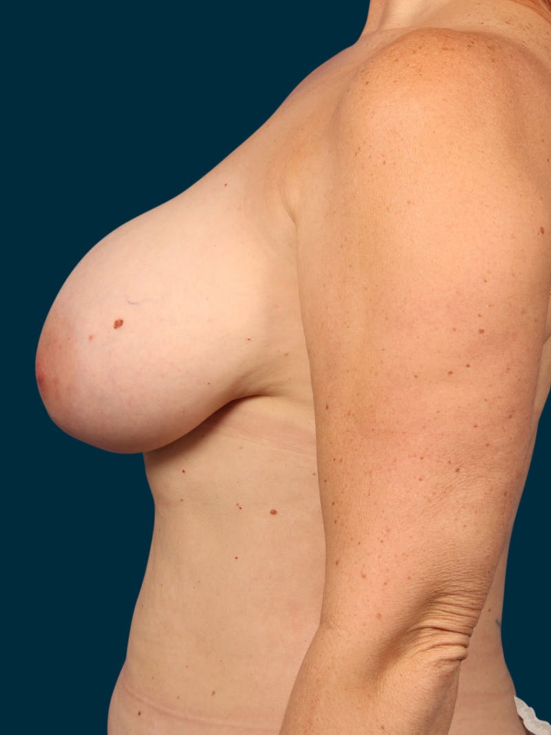 Breast Lift Before & After Gallery - Patient 498311 - Image 3