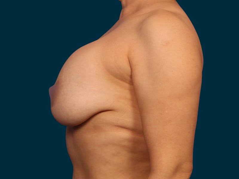 Breast Revision Before & After Gallery - Patient 377263 - Image 3