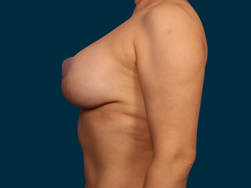 Breast Revision Before & After Gallery - Patient 377263 - Image 4