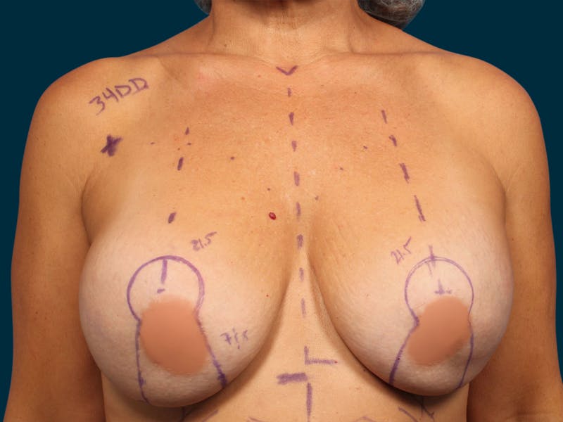 Breast Revision Before & After Gallery - Patient 224863 - Image 1