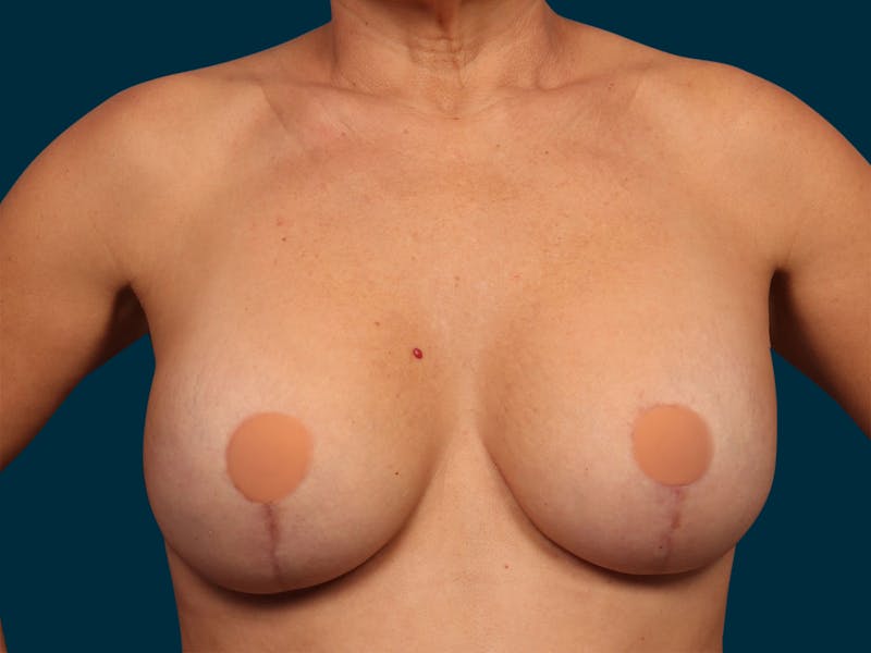 Breast Revision Before & After Gallery - Patient 224863 - Image 2