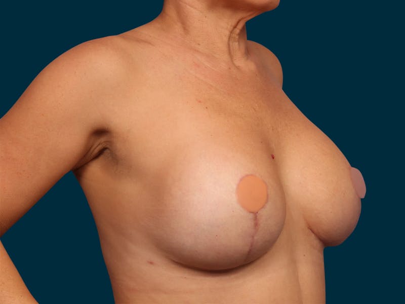 Breast Revision Before & After Gallery - Patient 224863 - Image 4