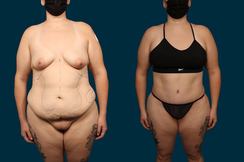 Patient zO65rVckSzazqJgl4vmbRQ - Liposuction Before & After Photos