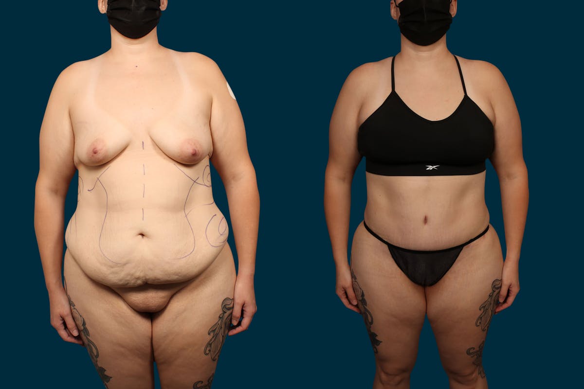 Abdominoplasty Before & After Gallery - Patient 352934 - Image 1