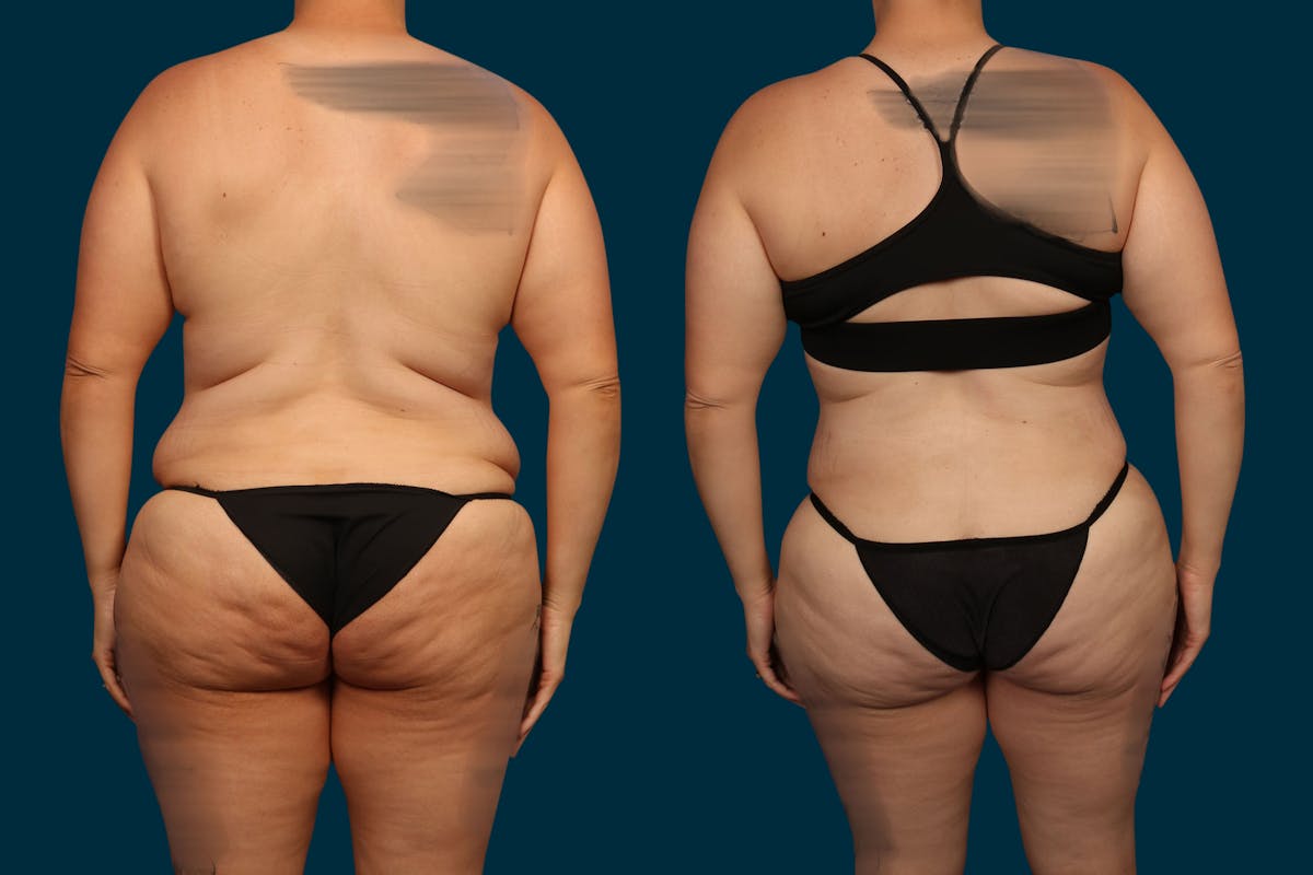 Liposuction Before & After Gallery - Patient 421649 - Image 2