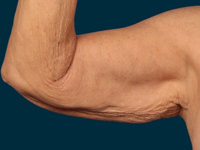 Brachioplasty Before & After Gallery - Patient 120831 - Image 1