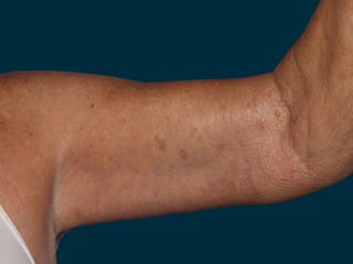 Brachioplasty Before & After Gallery - Patient 120831 - Image 4