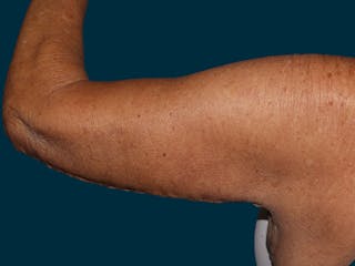 Brachioplasty Before & After Gallery - Patient 120831 - Image 6