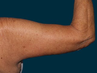 Brachioplasty Before & After Gallery - Patient 120831 - Image 8
