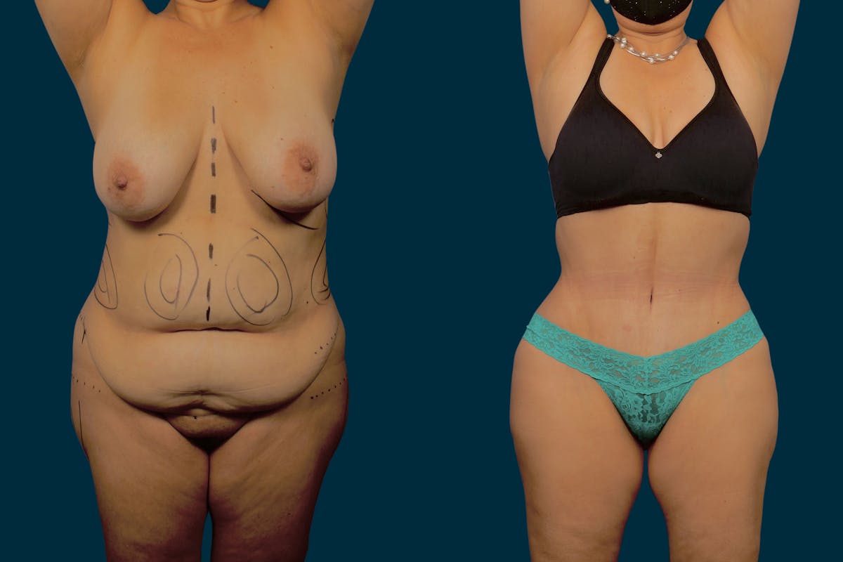 Abdominoplasty Before & After Gallery - Patient 277220 - Image 1