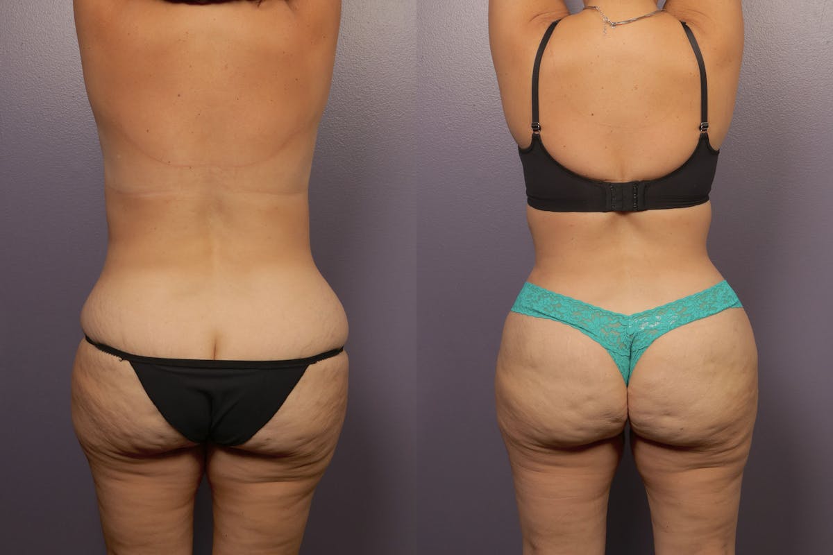 Liposuction Before & After Gallery - Patient 239280 - Image 2