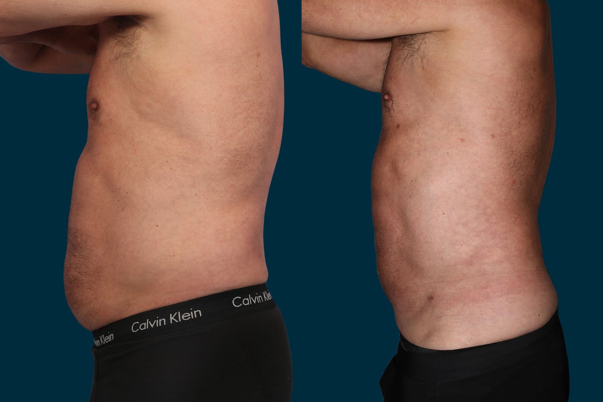 Liposuction Before & After Gallery - Patient 214414 - Image 1