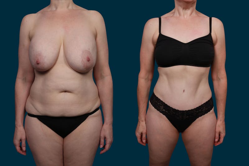 Patient 0H6GIbIgSWS5sIzQEqQbcw - Liposuction Before & After Photos