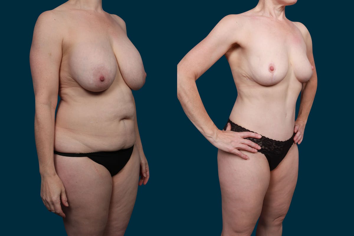 Liposuction Before & After Gallery - Patient 659725 - Image 2