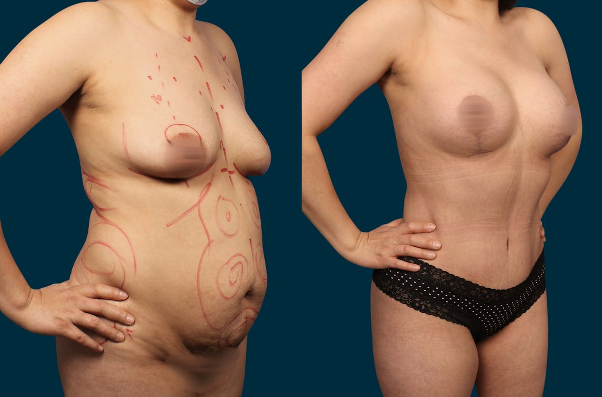 Mommy Makeover Before & After Gallery - Patient 367042 - Image 2