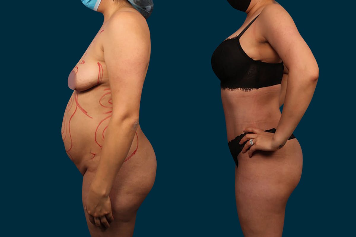 Abdominoplasty Before & After Gallery - Patient 400621 - Image 2