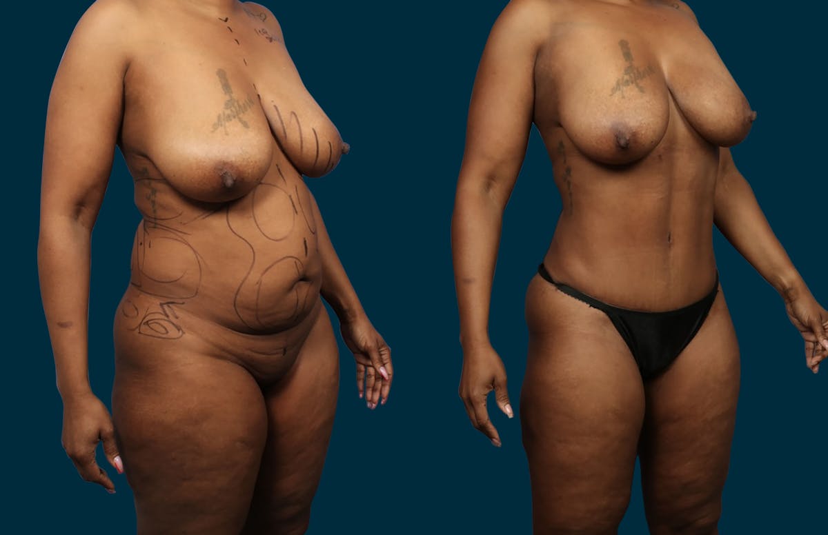 Liposuction Before & After Gallery - Patient 207376 - Image 2