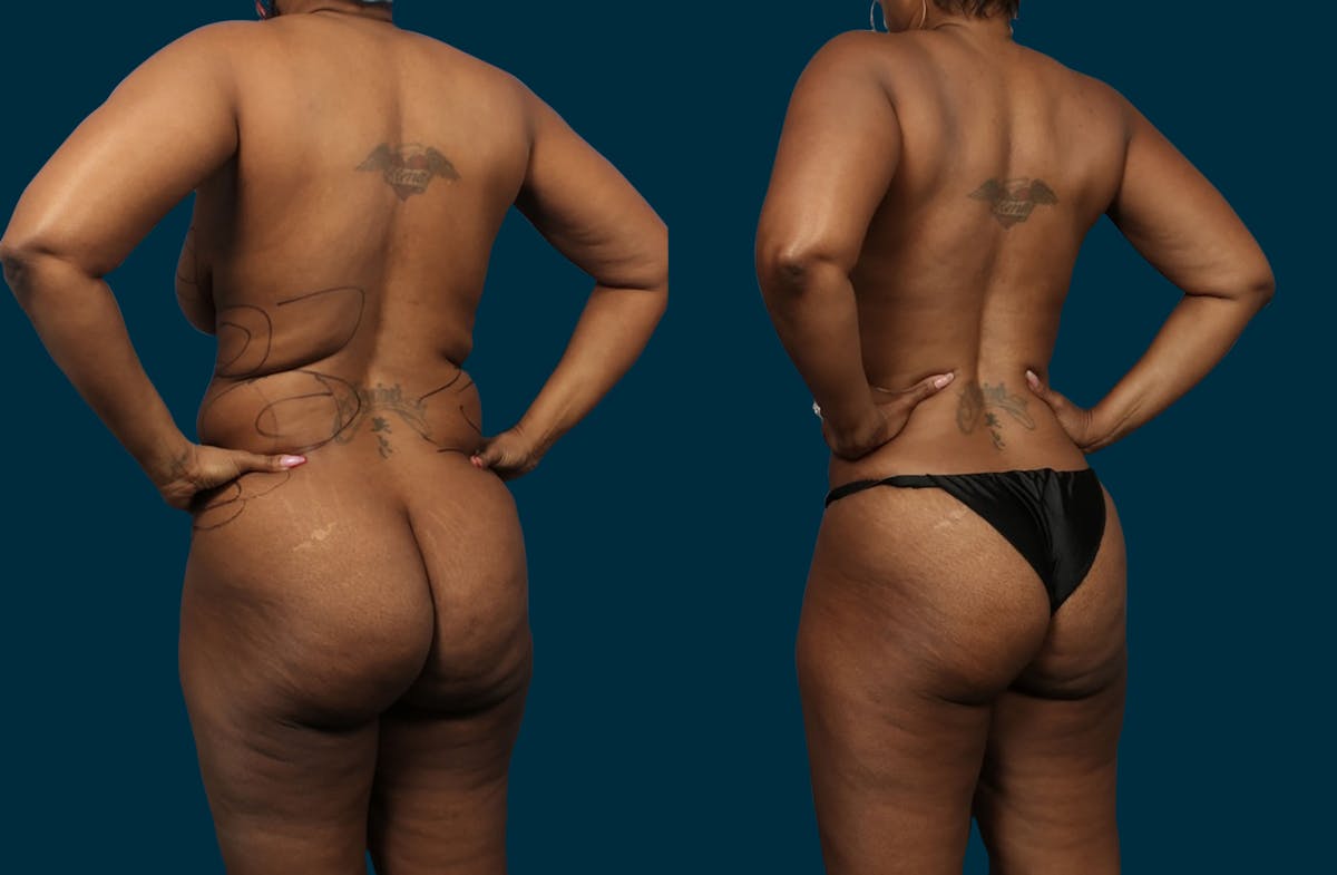 Liposuction Before & After Gallery - Patient 207376 - Image 3