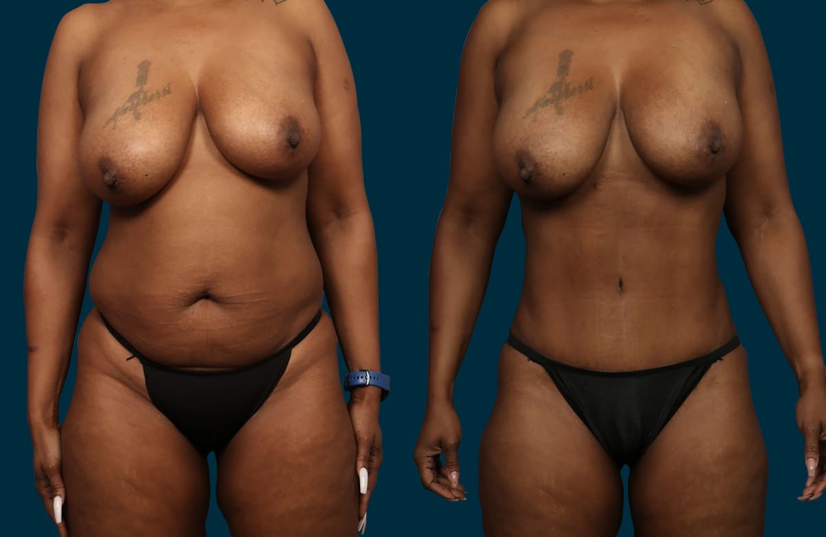 Abdominoplasty Before & After Gallery - Patient 117261 - Image 1