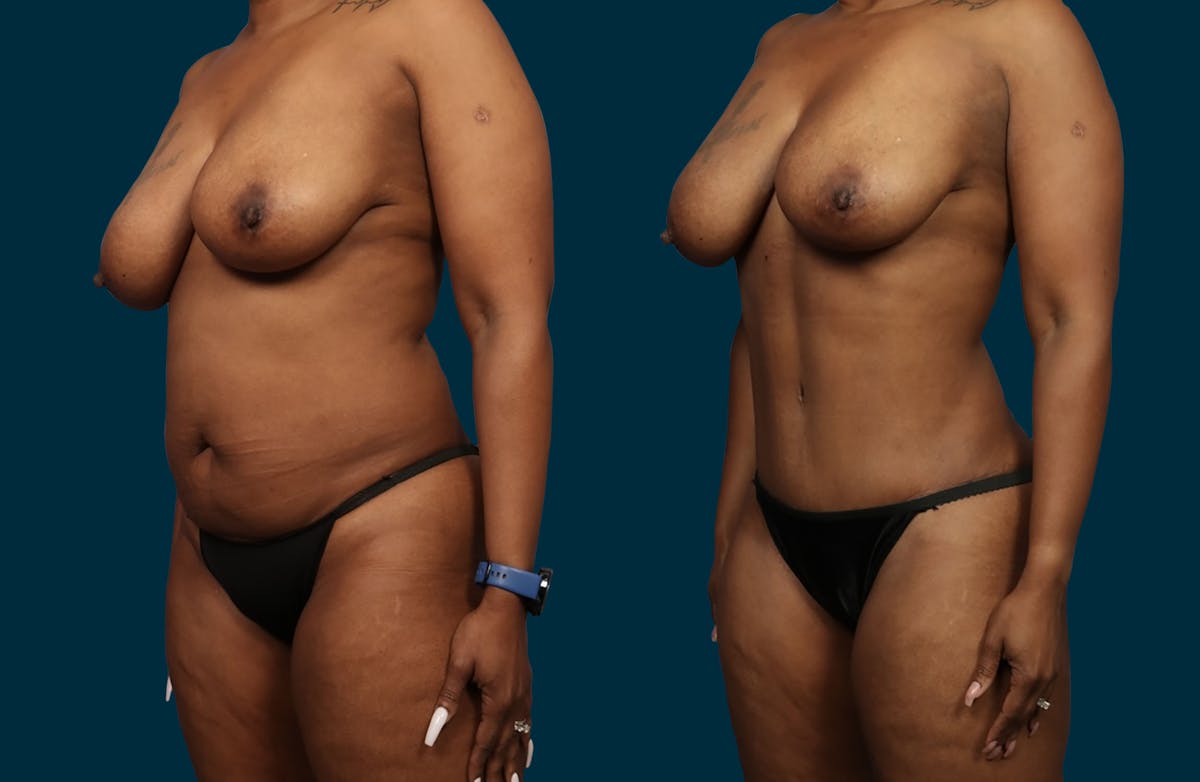 Liposuction Before & After Gallery - Patient 207376 - Image 4