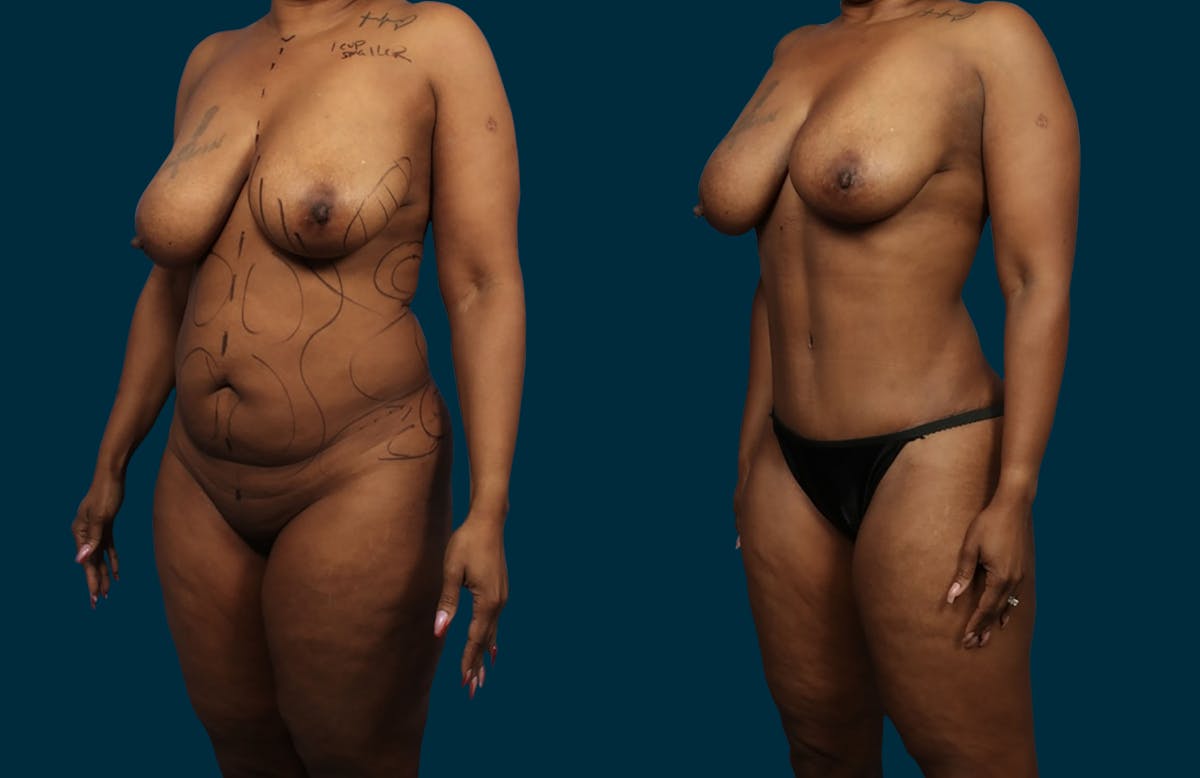 Abdominoplasty Before & After Gallery - Patient 117261 - Image 5