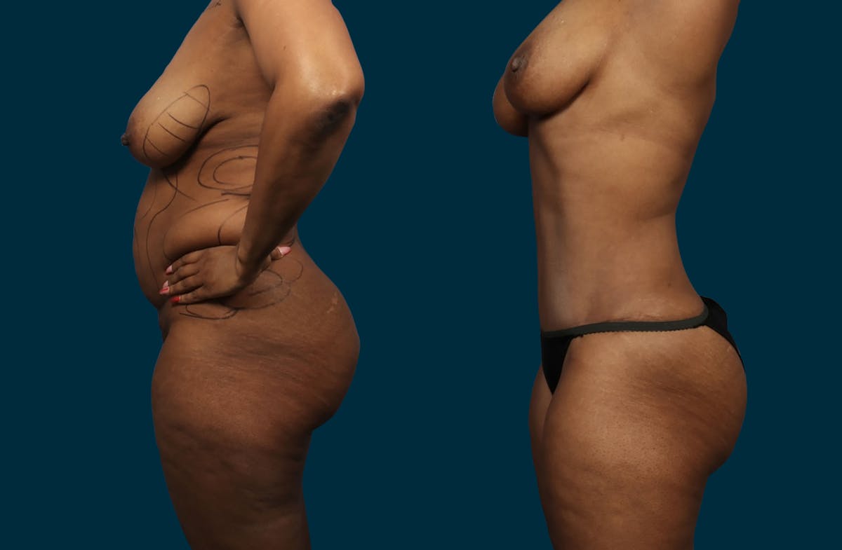 Liposuction Before & After Gallery - Patient 207376 - Image 6