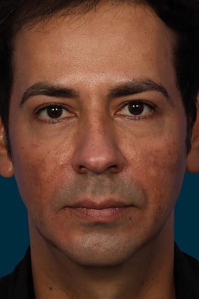 Botox Before & After Gallery - Patient 754041 - Image 2