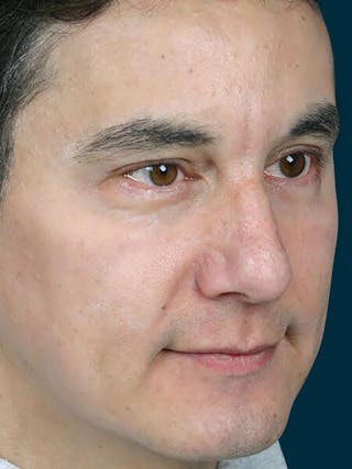 Botox Before & After Gallery - Patient 278232 - Image 4