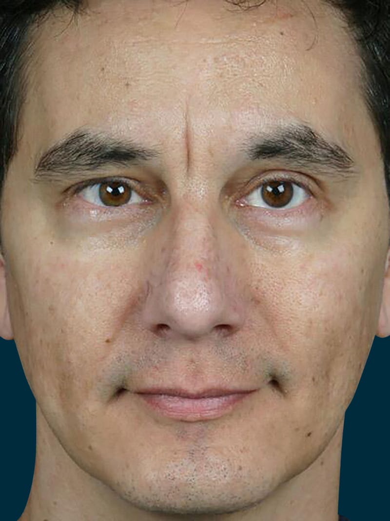 Botox Before & After Gallery - Patient 278232 - Image 1