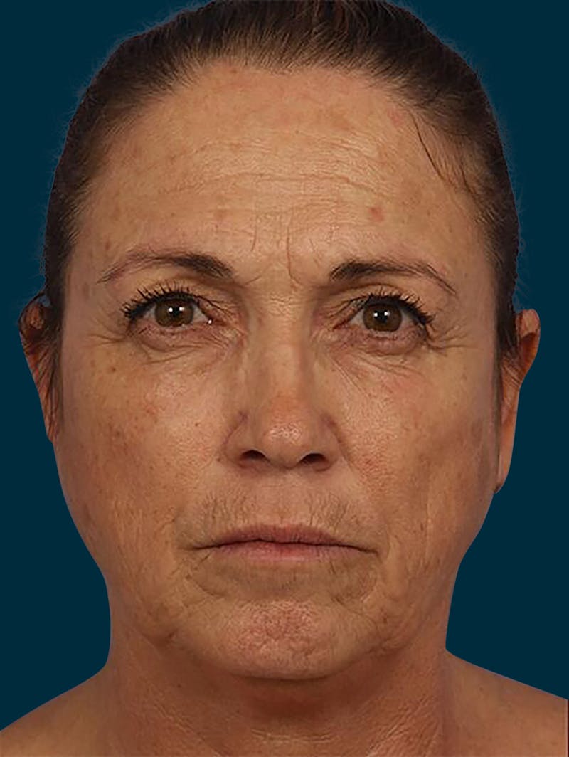 Botox Before & After Gallery - Patient 153960 - Image 1