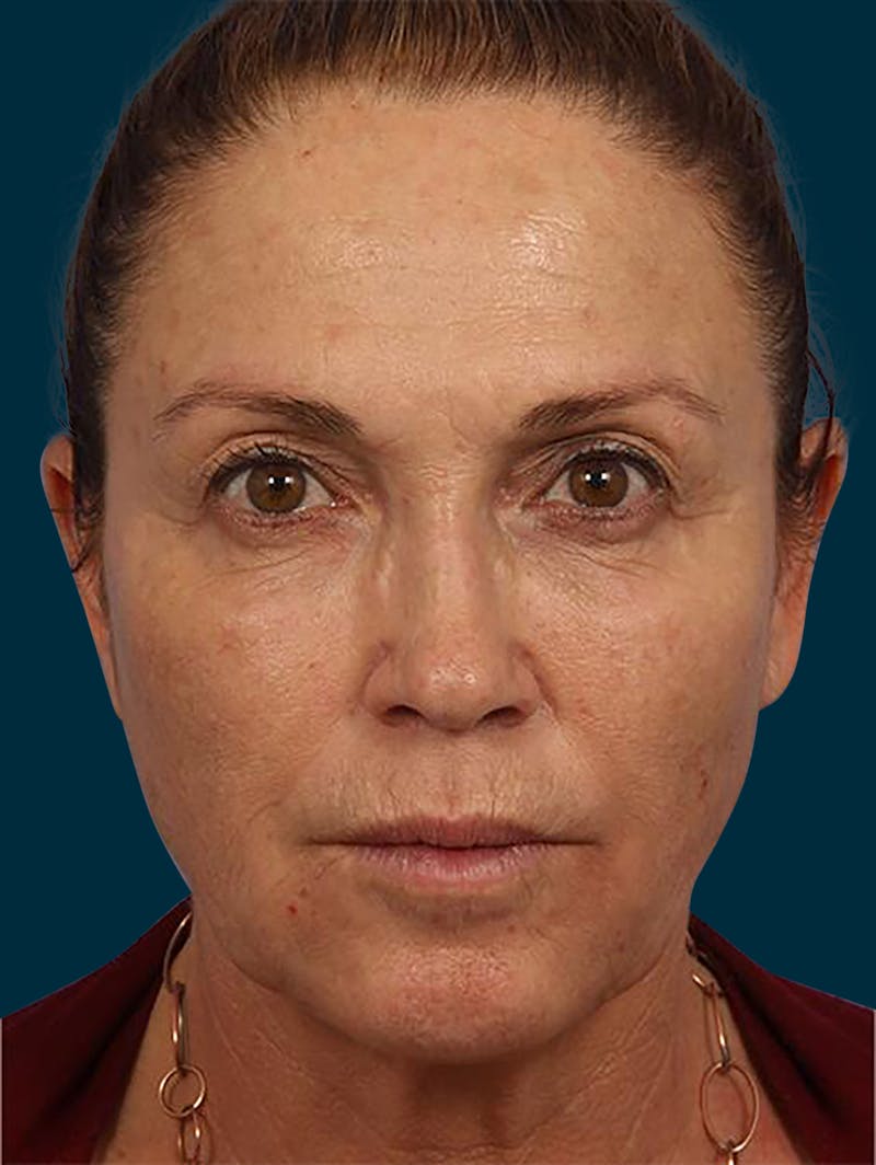 Botox Before & After Gallery - Patient 153960 - Image 2
