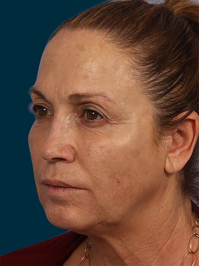 Botox Before & After Gallery - Patient 153960 - Image 4
