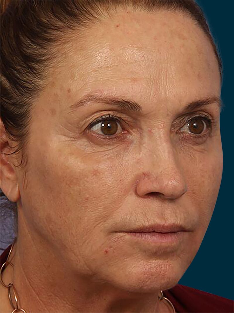 Botox Before & After Gallery - Patient 153960 - Image 6