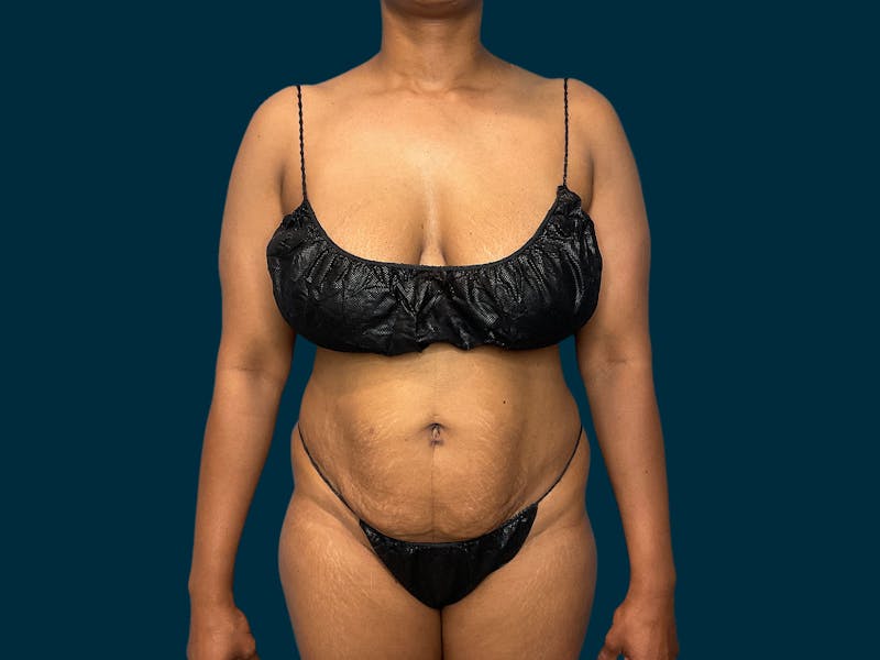 Patient XhJIG3tLQVq2dG-dVwVdiA - Tummy Tuck Before & After Photos