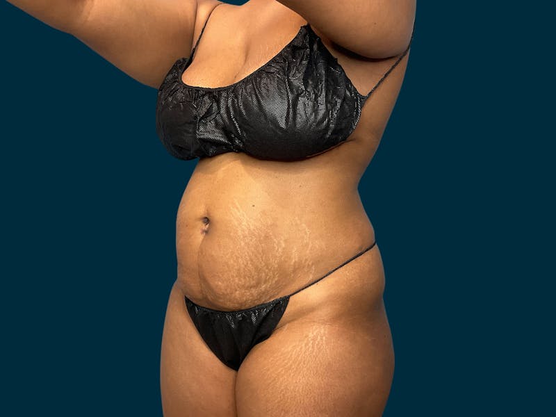 Abdominoplasty Before & After Gallery - Patient 145451 - Image 3