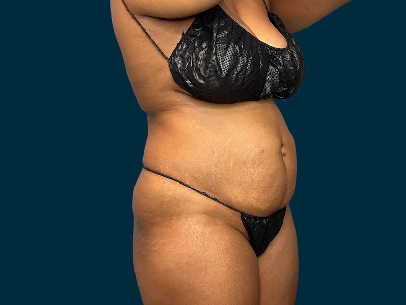 Abdominoplasty Before & After Gallery - Patient 145451 - Image 7