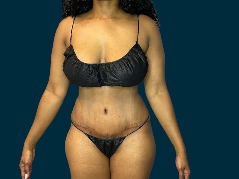 Abdominoplasty Before & After Gallery - Patient 145451 - Image 2
