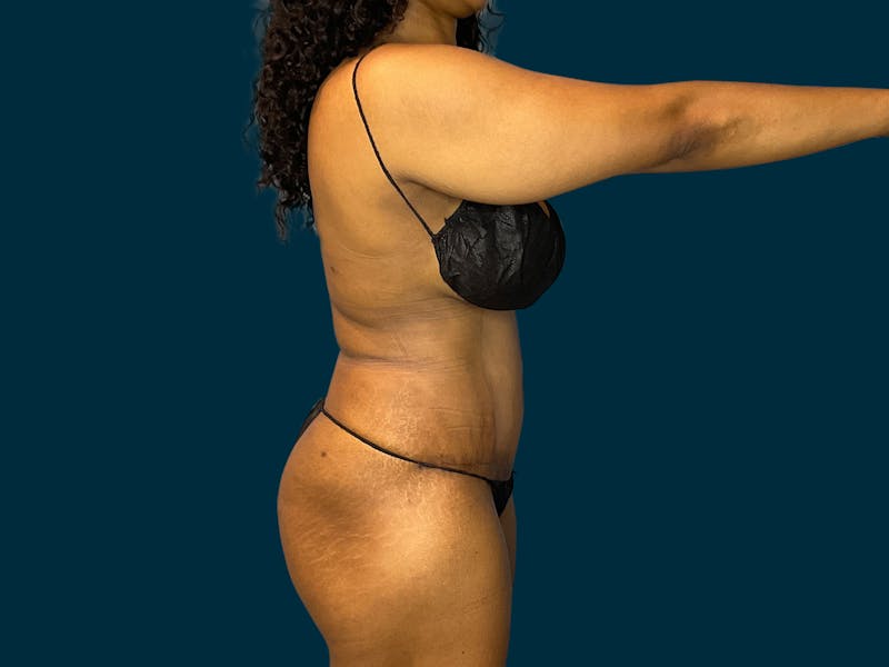 Abdominoplasty Before & After Gallery - Patient 145451 - Image 6