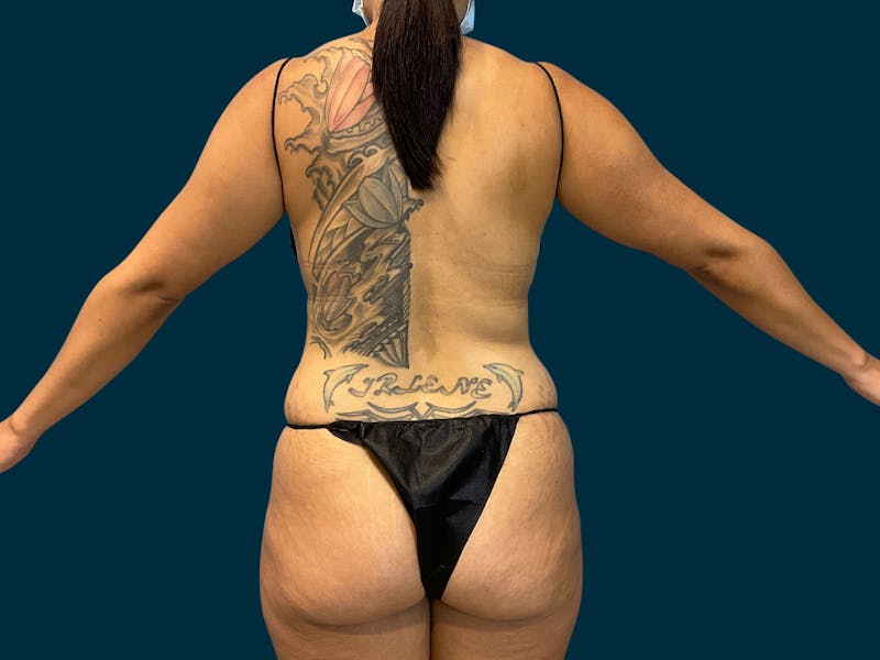Fat Transfer Before & After Gallery - Patient 289717 - Image 5