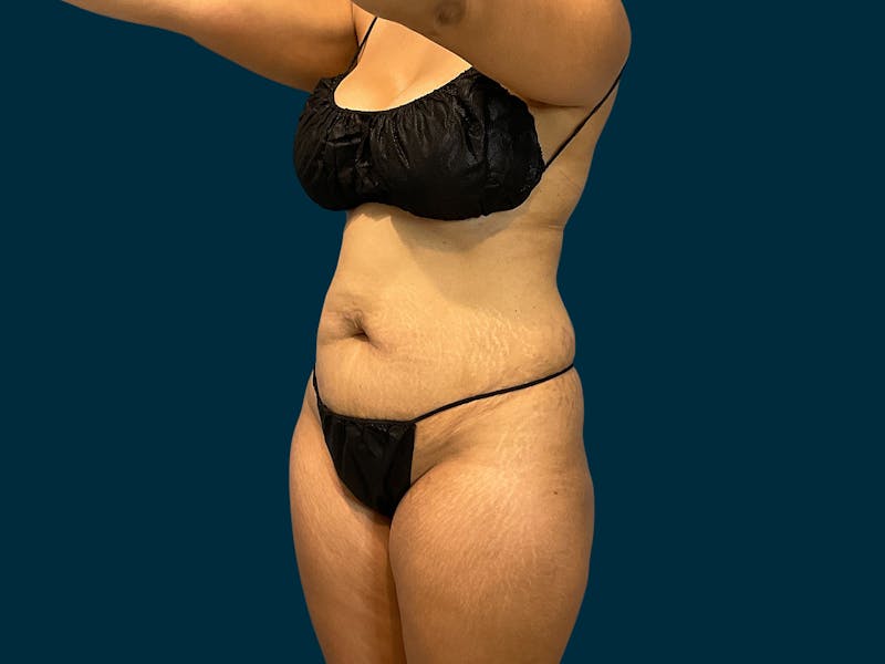 Fat Transfer Before & After Gallery - Patient 289717 - Image 1