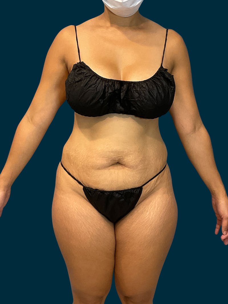 Patient tpij5s_YR1-0E1874bZpZA - Tummy Tuck Before & After Photos