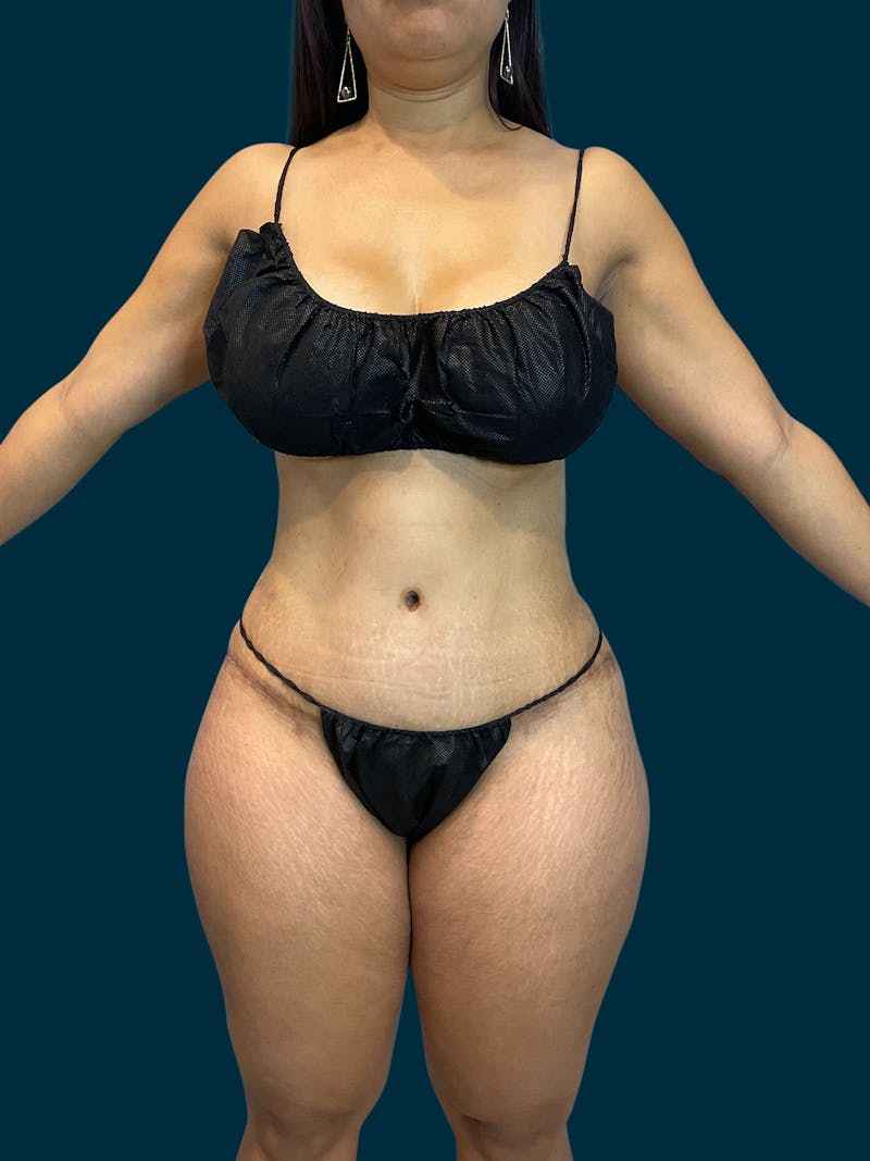 Fat Transfer Before & After Gallery - Patient 289717 - Image 4