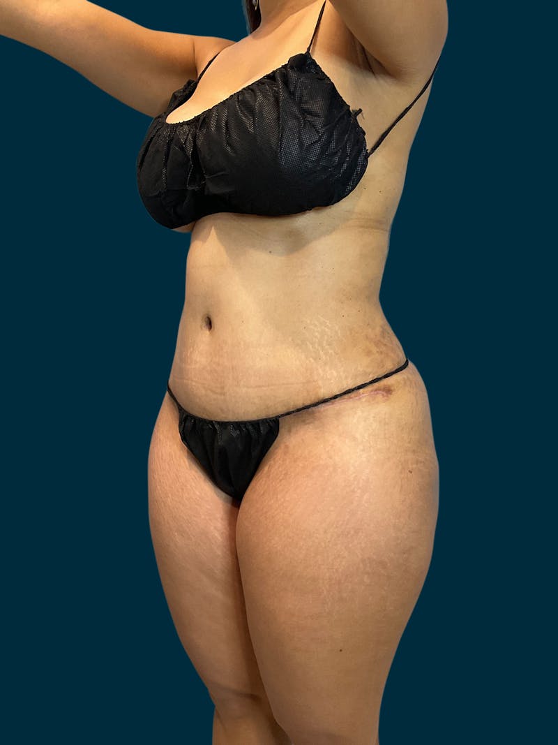 Fat Transfer Before & After Gallery - Patient 289717 - Image 2