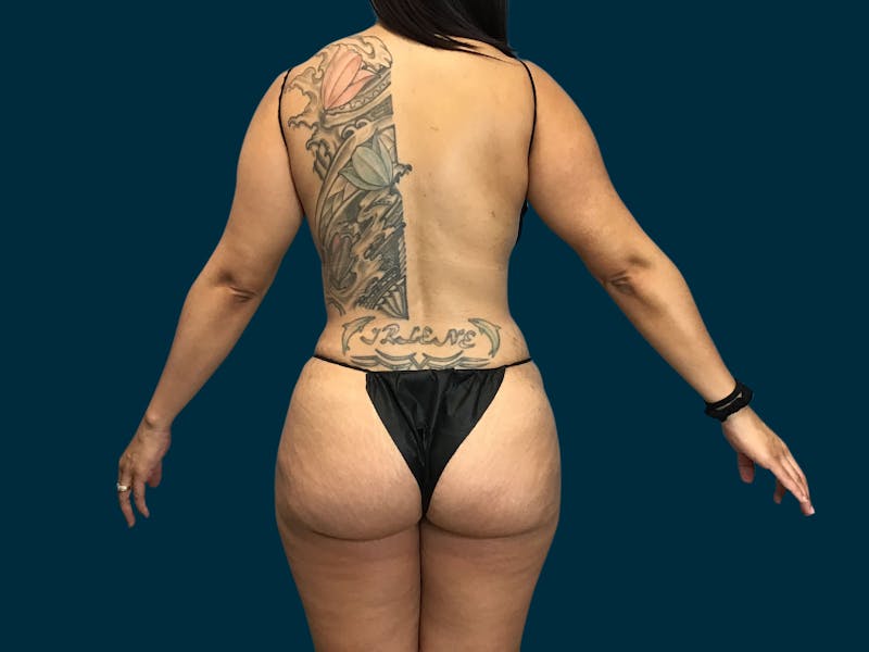 Fat Transfer Before & After Gallery - Patient 289717 - Image 6
