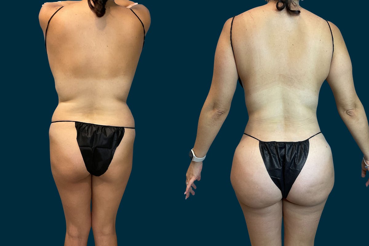 Liposuction Before & After Gallery - Patient 194068 - Image 1