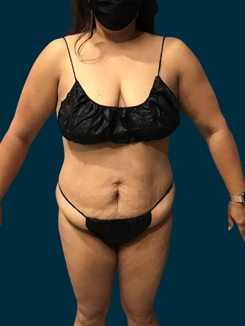 Liposuction Before & After Gallery - Patient 424806 - Image 3